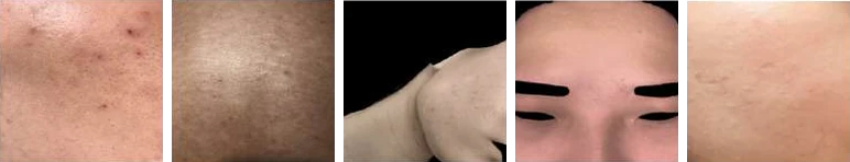 Anonymised smartphone acne photos from five trial participants